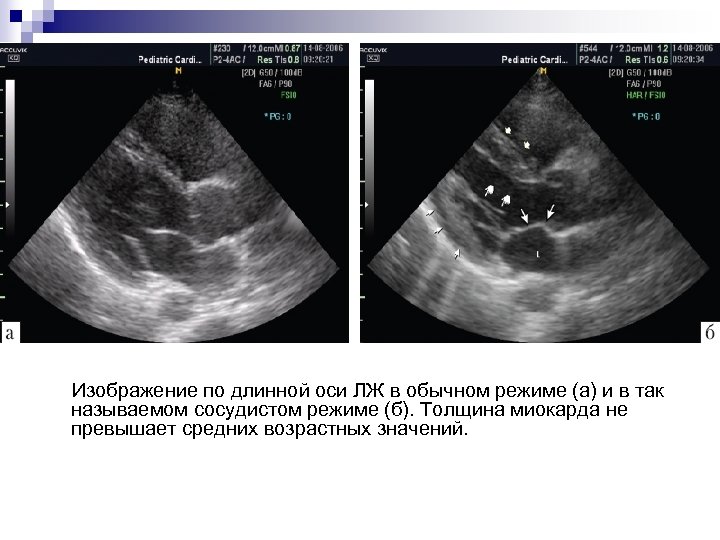  Изображение по длинной оси ЛЖ в обычном режиме (а) и в так называемом
