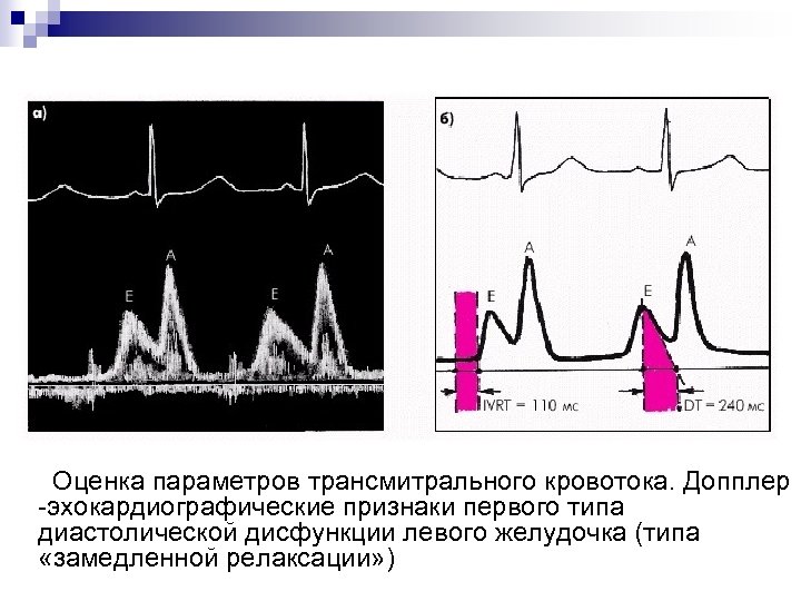 Дисфункция миокарда левого желудочка 1 тип. Трансмитральный кровоток норма. Пик е пик а ЭХОКГ. Диастолическая дисфункция тканевой допплер. Нарушение диастолической функции типы.