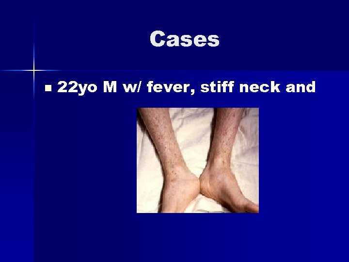 Cases n 22 yo M w/ fever, stiff neck and 