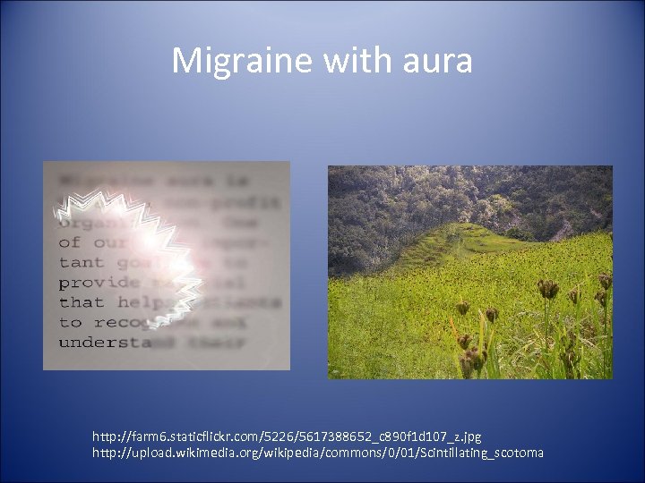 Migraine with aura http: //farm 6. staticflickr. com/5226/5617388652_c 890 f 1 d 107_z. jpg