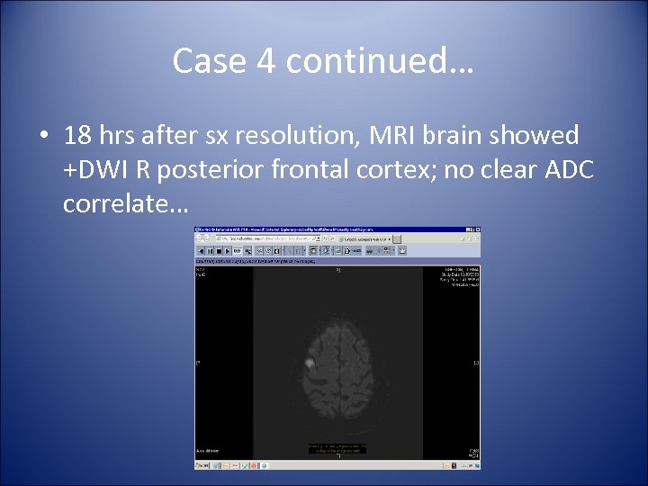 Case 4 continued… • 18 hrs after sx resolution, MRI brain showed +DWI R