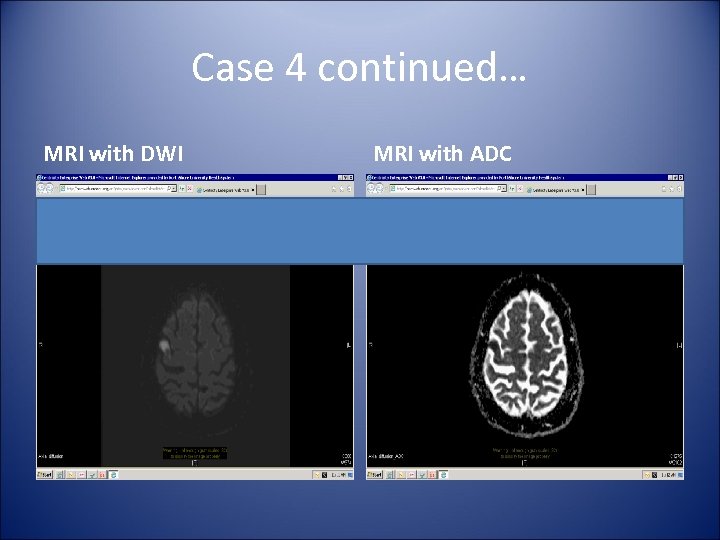 Case 4 continued… MRI with DWI MRI with ADC 