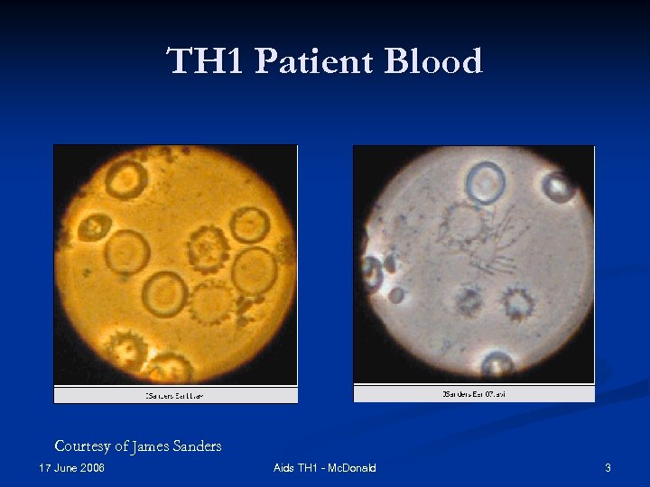 TH 1 Patient Blood Courtesy of James Sanders 17 June 2006 Aids TH 1