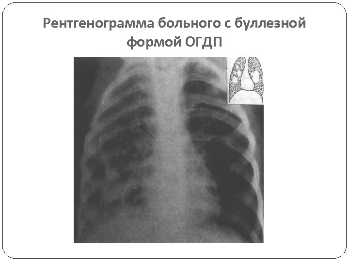 Рентгенограмма больного с буллезной формой ОГДП 