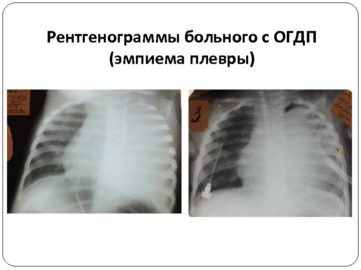 Рентгенограммы больного с ОГДП (эмпиема плевры) 