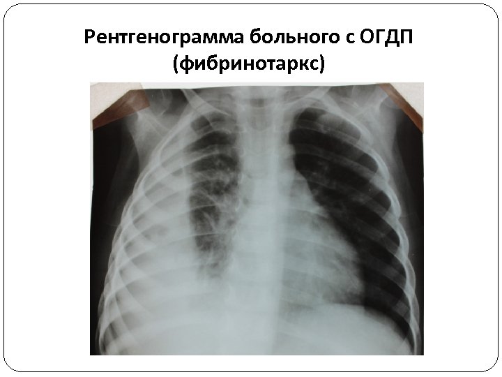 Рентгенограмма больного с ОГДП (фибринотаркс) 