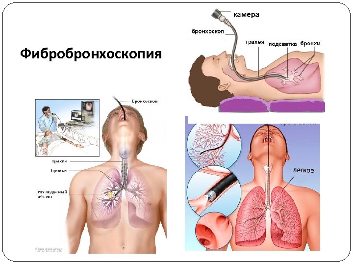 Схема бронхов эндоскопия