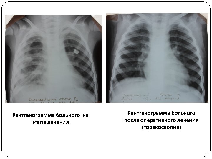 Рентгенограмма больного на этапе лечения Рентгенограмма больного после оперативного лечения (торакоскопия) 