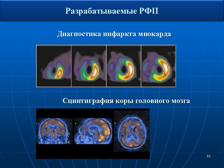 Разрабатываемые РФП Диагностика инфаркта миокарда Диагностика инфаркта Сцинтиграфия коры головного мозга 32 