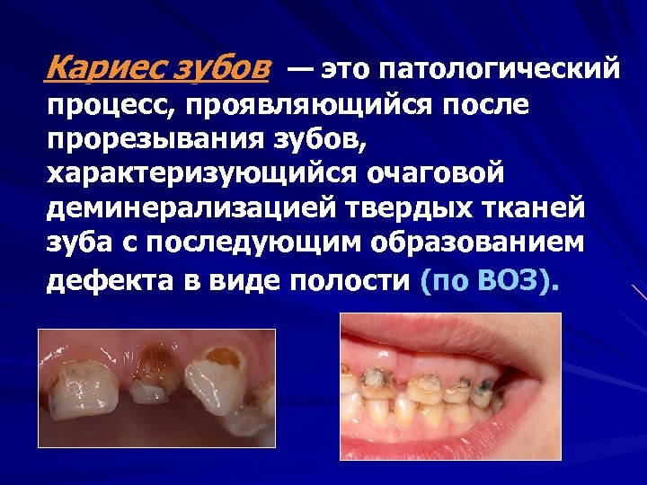 Кариес зубов — это патологический процесс, проявляющийся после прорезывания зубов, характеризующийся очаговой деминерализацией твердых