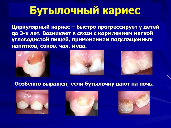 Бутылочный кариес Циркулярный кариес – быстро прогрессирует у детей до 3 -х лет. Возникает