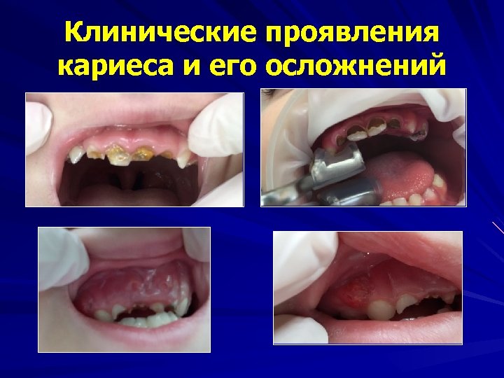 Клинические проявления кариеса и его осложнений 