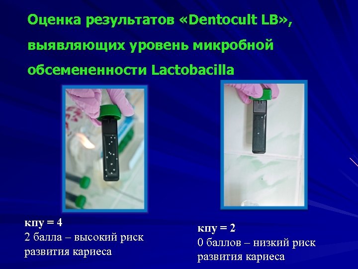 Оценка результатов «Dentocult LB» , выявляющих уровень микробной обсемененности Laсtobacillа кпу = 4 2