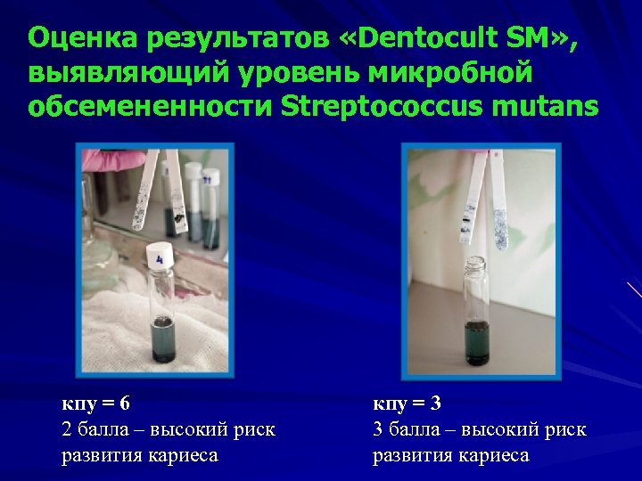 Оценка результатов «Dentocult SM» , выявляющий уровень микробной обсемененности Streptococcus mutans кпу = 6