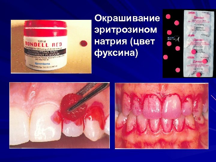 Окрашивание эритрозином натрия (цвет фуксина) 