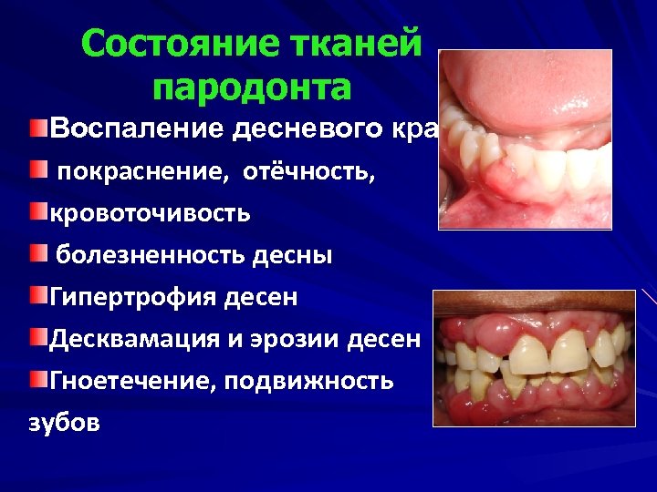 Состояние тканей пародонта Воспаление десневого края покраснение, отёчность, кровоточивость болезненность десны Гипертрофия десен Десквамация