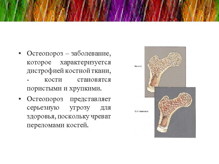  • Остеопороз – заболевание, которое характеризуется дистрофией костной ткани, - кости становятся пористыми