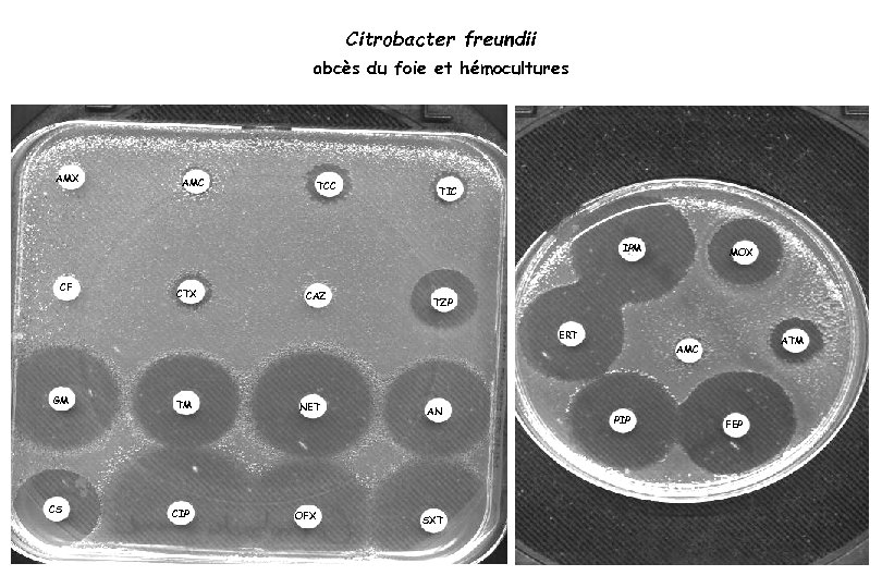 Citrobacter freundii abcès du foie et hémocultures AMX AMC TCC TIC IPM CF CTX