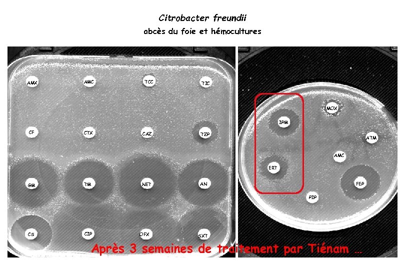 Citrobacter freundii abcès du foie et hémocultures AMX AMC TCC TIC MOX IPM CF