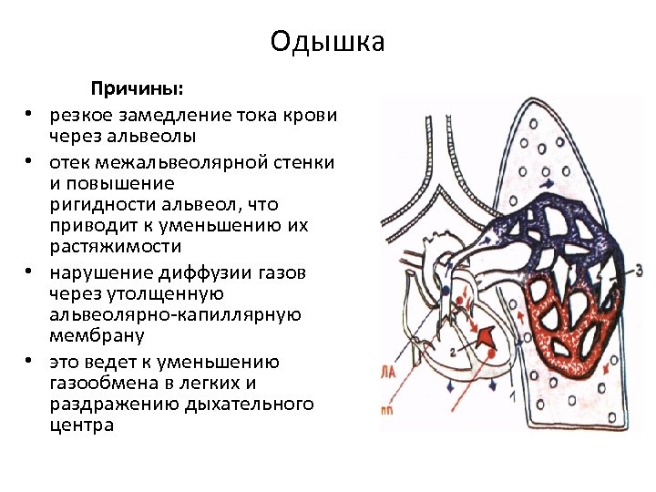 Одышка • • Причины: резкое замедление тока крови через альвеолы отек межальвеолярной стенки и