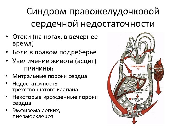 Синдром правожелудочковой сердечной недостаточности • Отеки (на ногах, в вечернее время) • Боли в