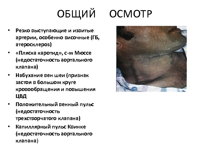 ОБЩИЙ • Резко выступающие и извитые артерии, особенно височные (ГБ, атеросклероз) • «Пляска каротид»