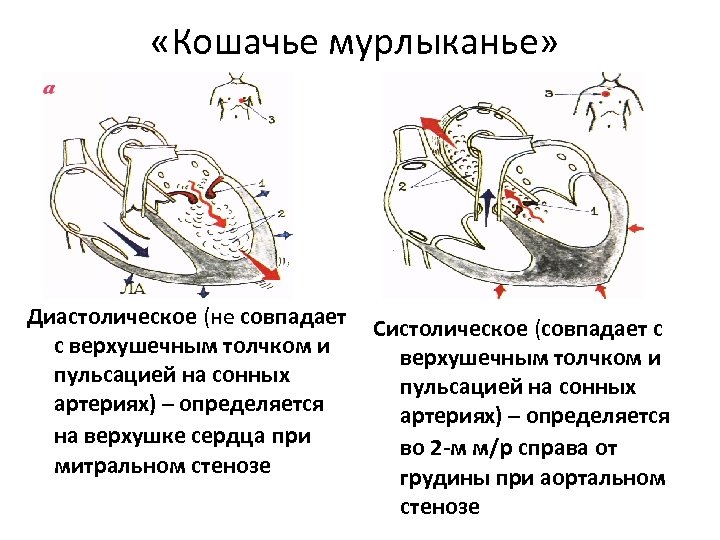  «Кошачье мурлыканье» Диастолическое (не совпадает с верхушечным толчком и пульсацией на сонных артериях)