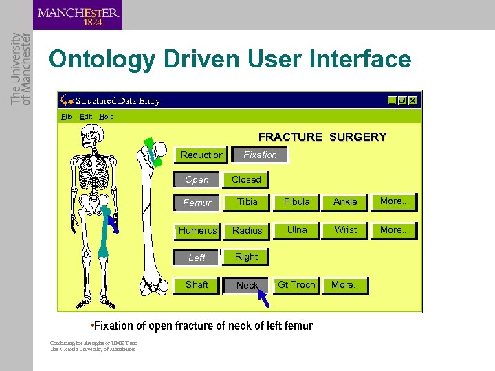Ontology Driven User Interface Structured Data Entry File Edit Help FRACTURE SURGERY Reduction Fixation