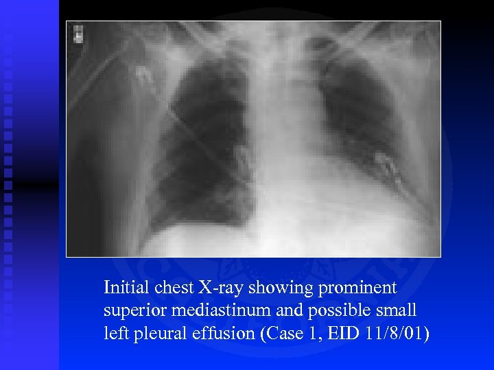 Initial chest X-ray showing prominent superior mediastinum and possible small left pleural effusion (Case