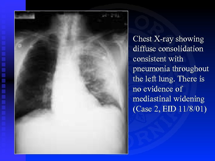 Chest X-ray showing diffuse consolidation consistent with pneumonia throughout the left lung. There is