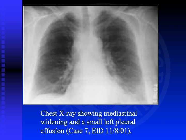 Chest X-ray showing mediastinal widening and a small left pleural effusion (Case 7, EID