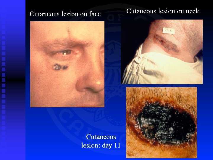 Cutaneous lesion on face Cutaneous lesion: day 11 Cutaneous lesion on neck 