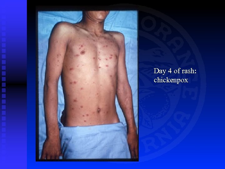 Day 4 of rash: chickenpox 