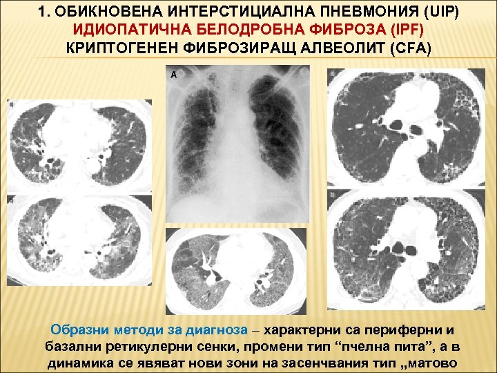 1. ОБИКНОВЕНА ИНТЕРСТИЦИАЛНА ПНЕВМОНИЯ (UIP) ИДИОПАТИЧНА БЕЛОДРОБНА ФИБРОЗА (IPF) КРИПТОГЕНЕН ФИБРОЗИРАЩ АЛВЕОЛИТ (CFA) Образни