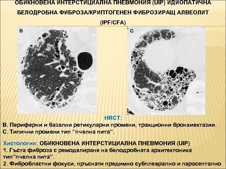 ОБИКНОВЕНА ИНТЕРСТИЦИАЛНА ПНЕВМОНИЯ (UIP) ИДИОПАТИЧНА БЕЛОДРОБНА ФИБРОЗА/КРИПТОГЕНЕН ФИБРОЗИРАЩ АЛВЕОЛИТ (IPF/CFA) HRCT: B. Периферни и
