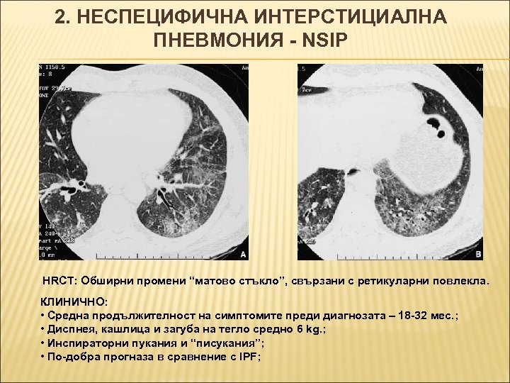 2. НЕСПЕЦИФИЧНА ИНТЕРСТИЦИАЛНА ПНЕВМОНИЯ - NSIP HRCT: Обширни промени “матово стъкло”, свързани с ретикуларни