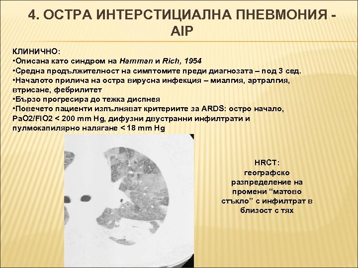 4. ОСТРА ИНТЕРСТИЦИАЛНА ПНЕВМОНИЯ AIP КЛИНИЧНО: • Описана като синдром на Hamman и Rich,