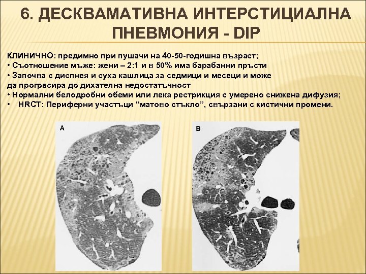 6. ДЕСКВАМАТИВНА ИНТЕРСТИЦИАЛНА ПНЕВМОНИЯ - DIP КЛИНИЧНО: предимно при пушачи на 40 -50 -годишна