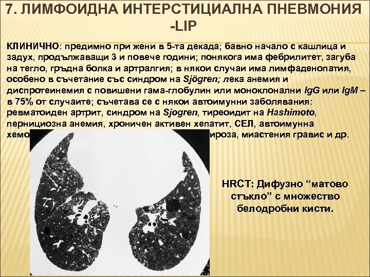 7. ЛИМФОИДНА ИНТЕРСТИЦИАЛНА ПНЕВМОНИЯ -LIP КЛИНИЧНО: предимно при жени в 5 -та декада; бавно