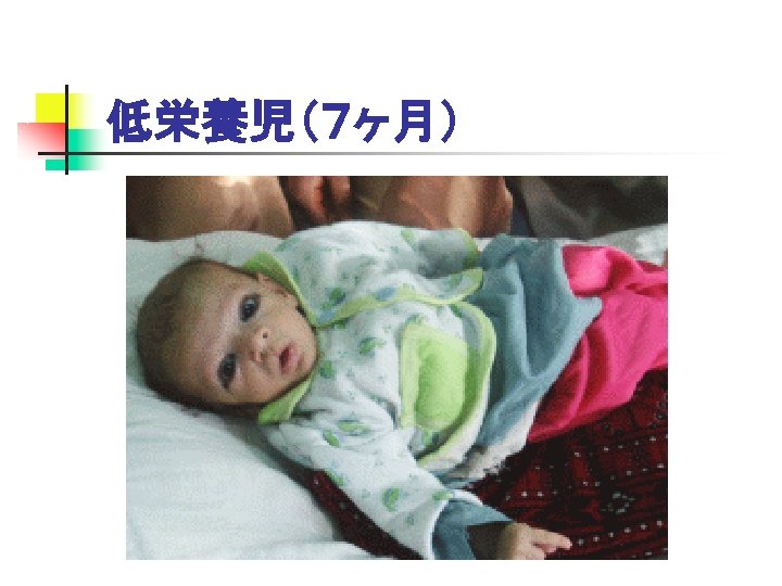 低栄養児（７ヶ月） 
