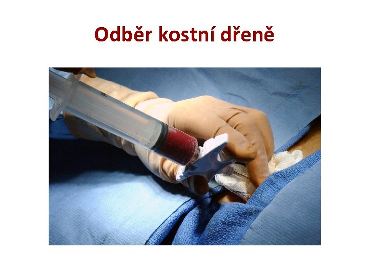 Odběr kostní dřeně 