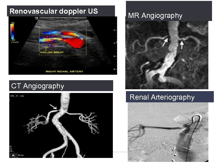 Renovascular doppler US MR Angiography CT Angiography Renal Arteriography 