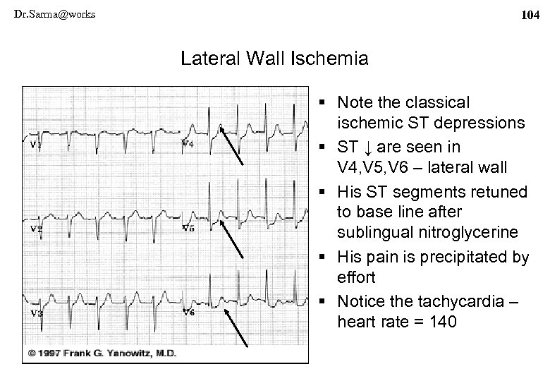 Dr. Sarma@works 104 Lateral Wall Ischemia § Note the classical ischemic ST depressions §