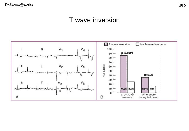 Dr. Sarma@works 105 T wave inversion 