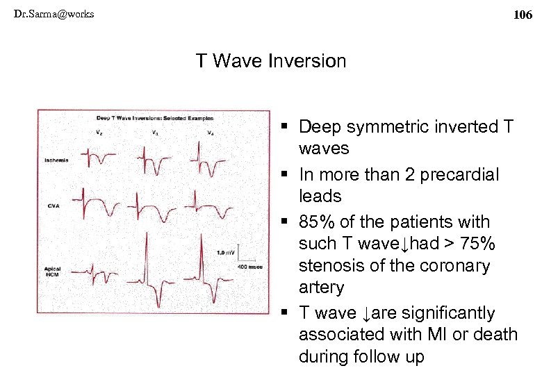 Dr. Sarma@works 106 T Wave Inversion § Deep symmetric inverted T waves § In
