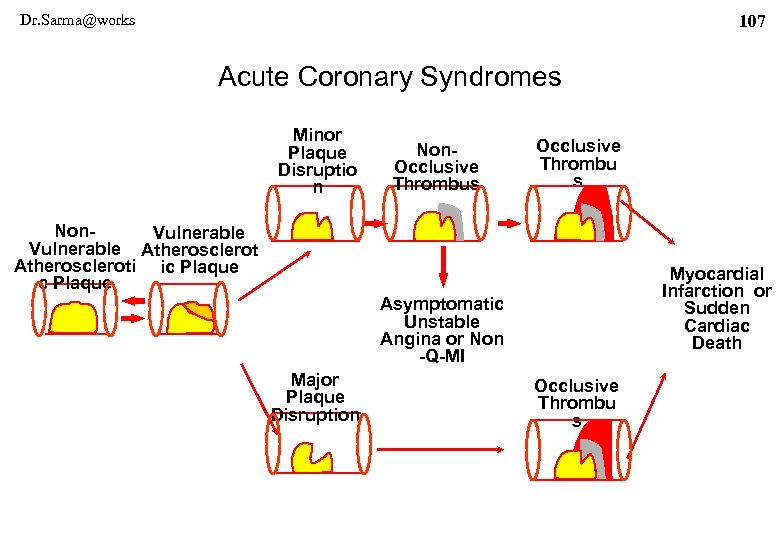 Dr. Sarma@works 107 Acute Coronary Syndromes Minor Plaque Disruptio n Non. Occlusive Thrombus Occlusive