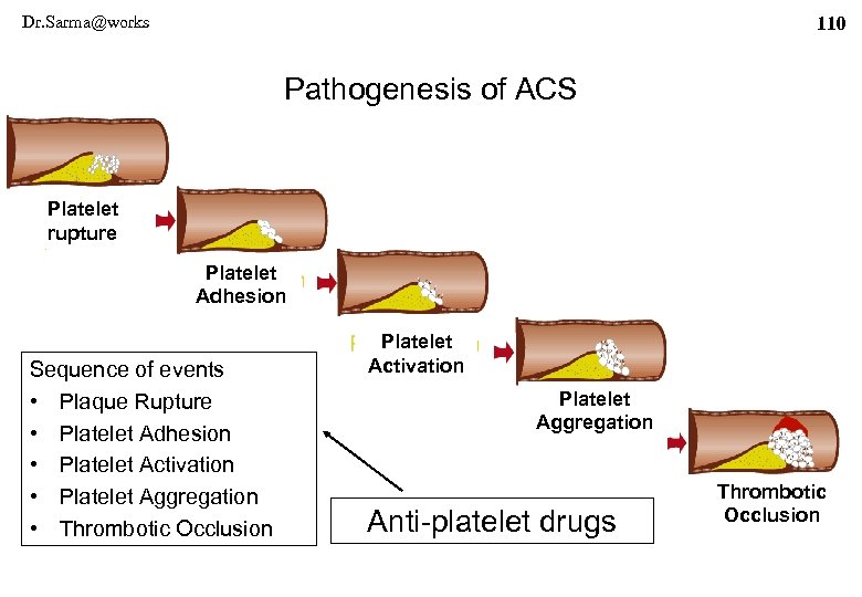Dr. Sarma@works 110 Pathogenesis of ACS Platelet rupture Platelet Adhesion Sequence of events •