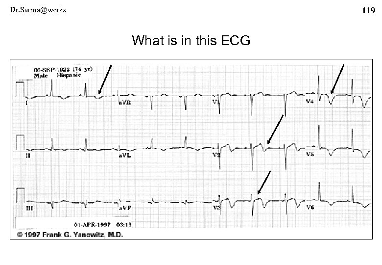 Dr. Sarma@works 119 What is in this ECG 