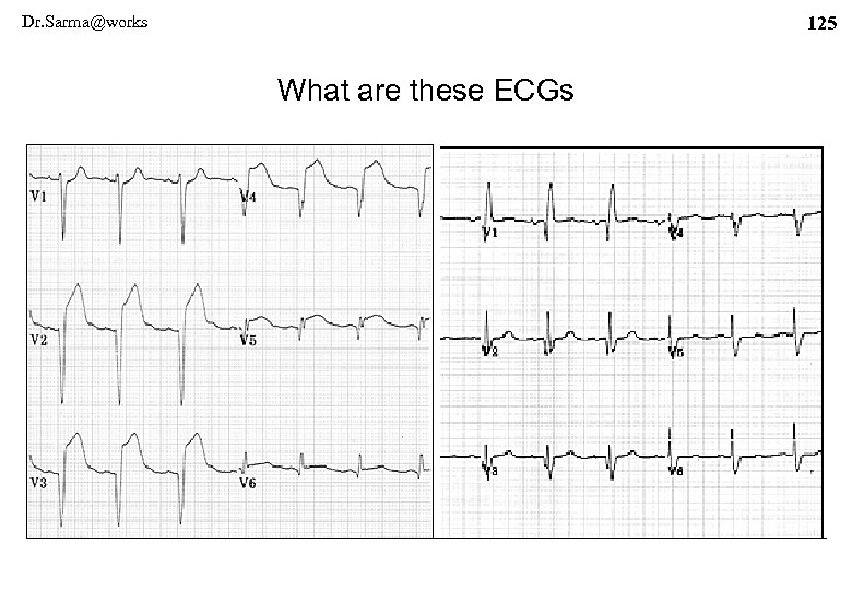 Dr. Sarma@works 125 What are these ECGs 