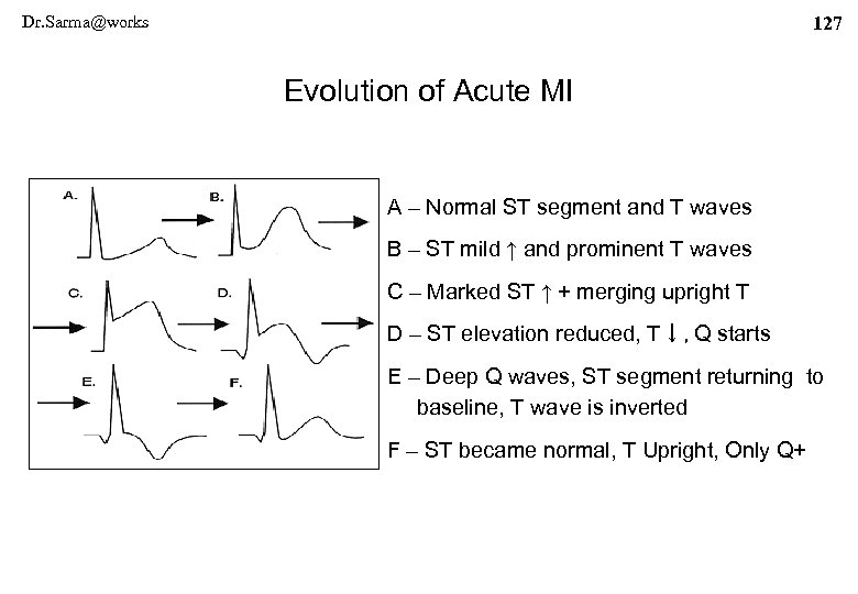 Dr. Sarma@works 127 Evolution of Acute MI A – Normal ST segment and T